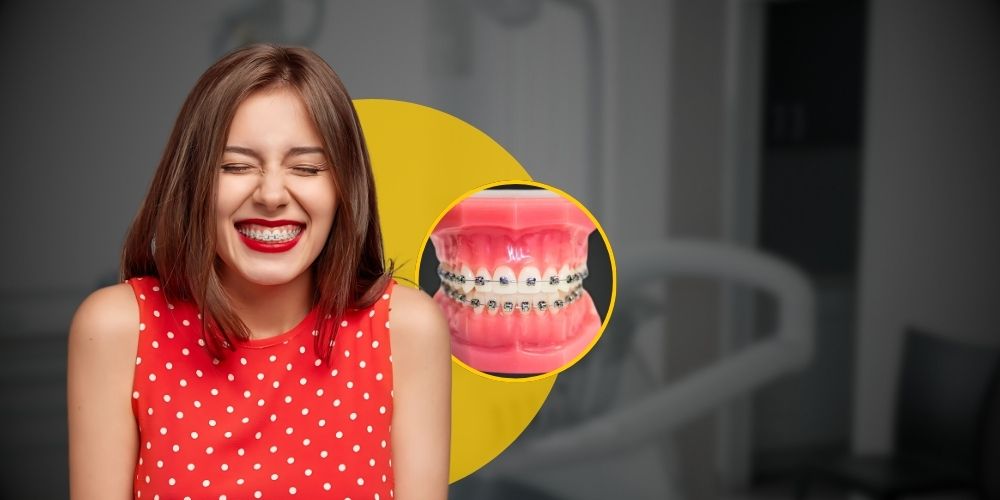 Damon-Braces-Treatment