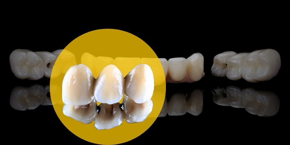 Dental-Crown-Bridge-Treatment